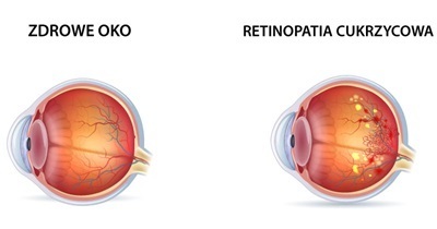 Retinopatia oka